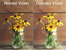 cataractvision